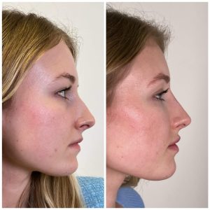 no-filter-clinic-face-balancing-results-1.jpg