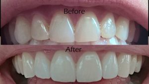 Dental-Veneer-4.jpg